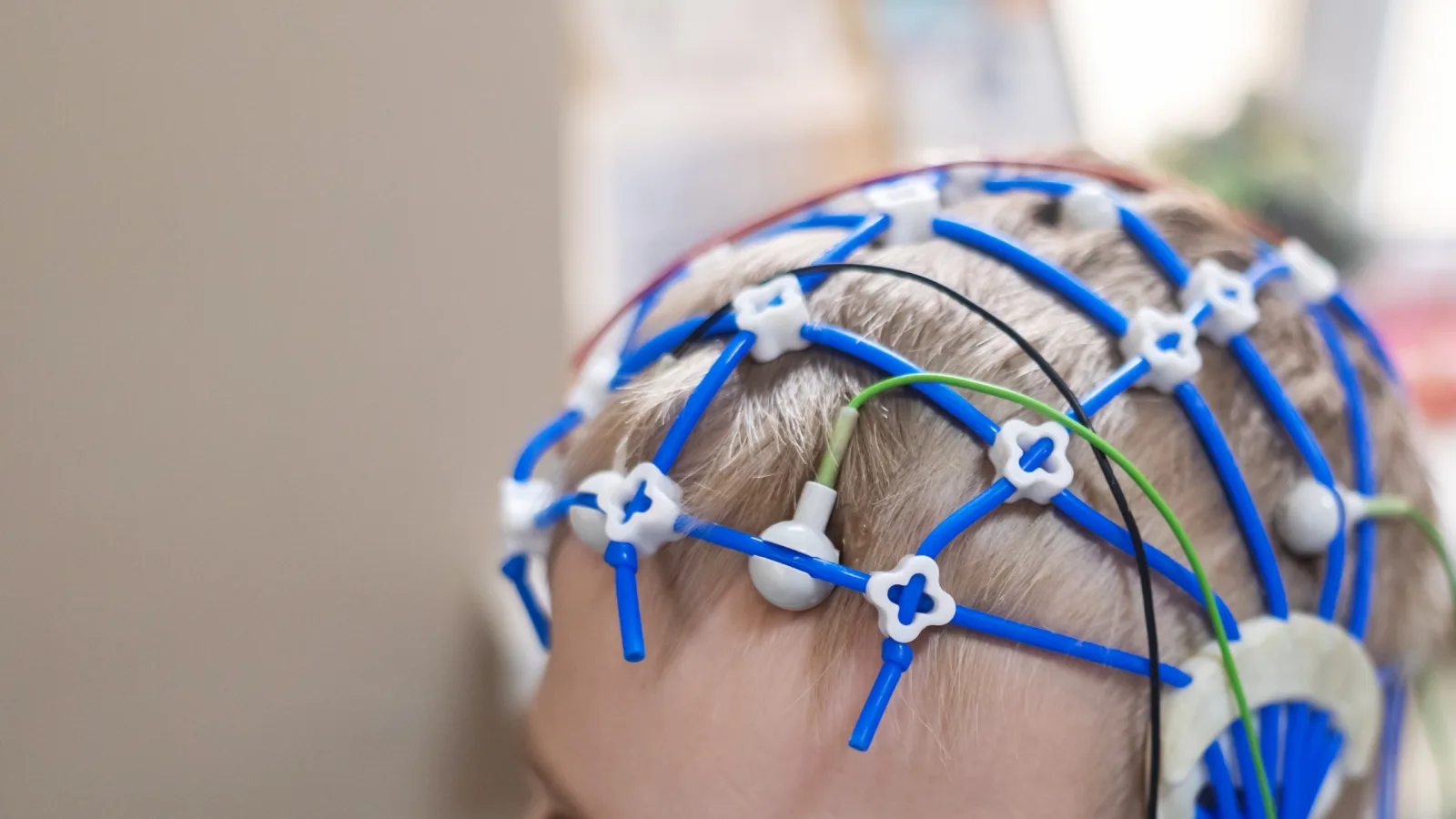 How many neurofeedback sessions are needed